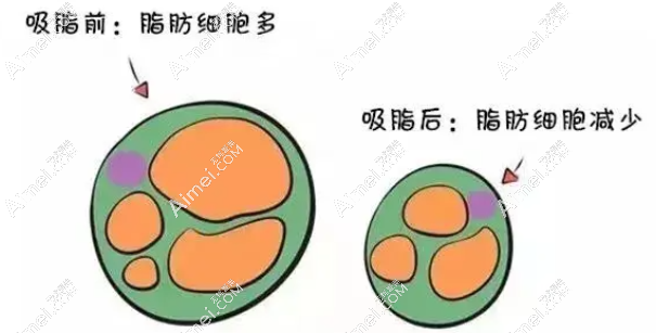 北京吸脂特色机构排名推荐