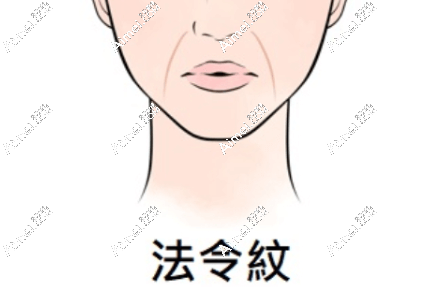 2025法令纹医美去除方法:拉皮/热玛吉/玻尿酸/埋线提升都有成效,怎么选看这!