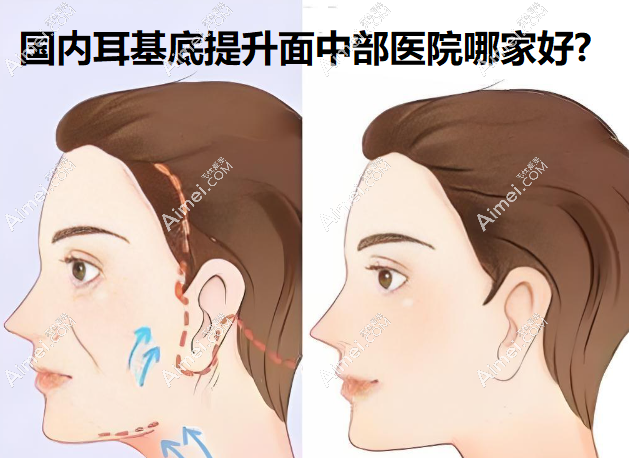 国内耳基底提升面中部医院医生哪家好?2025排名前十口碑评分皆4.5以上可放心选