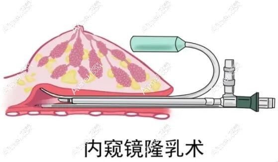 何贤清擅长内窥镜假体隆胸手术技术超好