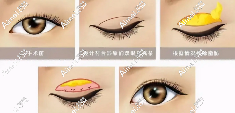 郑小红医生眼修复 郑小红医生眼修复