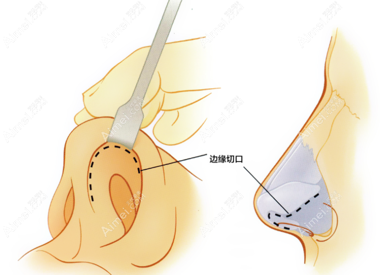 aimei.com李信锋医生隆鼻 aimei.com李信锋医生隆鼻