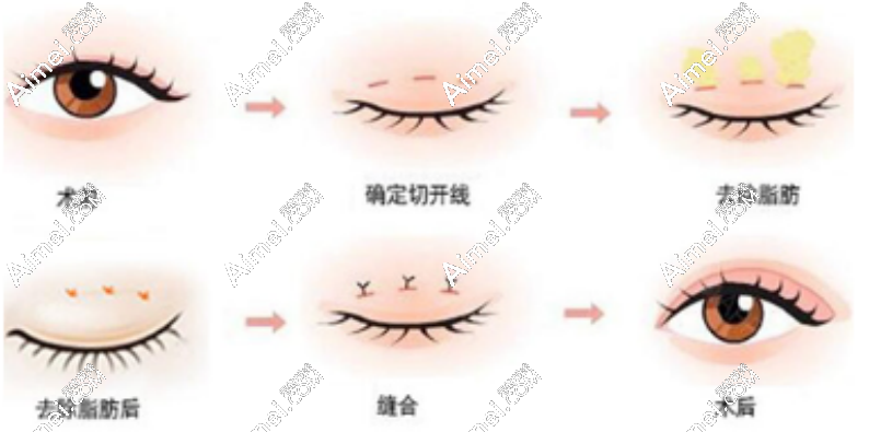 郑小红医生眼修复 郑小红医生眼修复