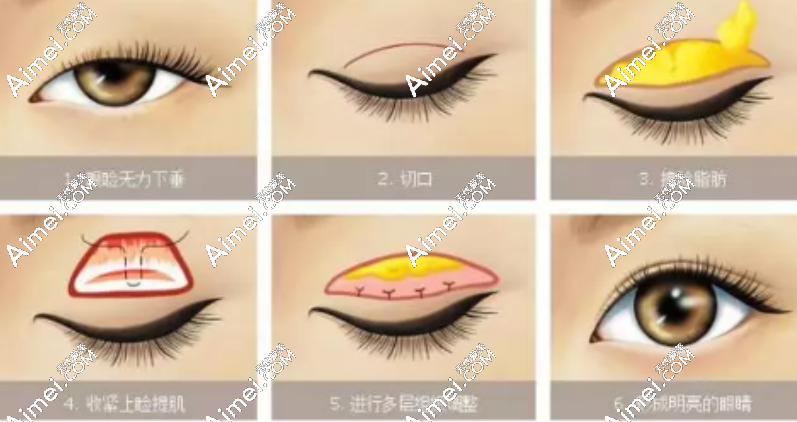 aimei.com郑小红医生眼修复 aimei.com郑小红医生眼修复