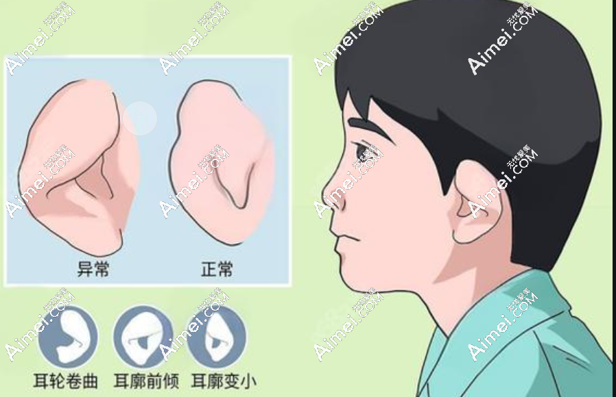 康春雨耳再造二期圖片查看:一起看看康春雨做過的耳再造的患者分享