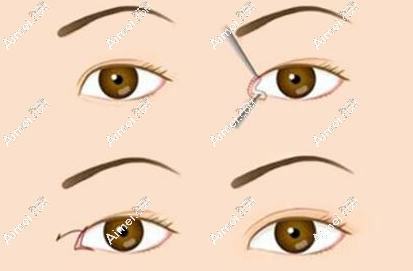 网传北京李燕双眼皮避雷?听双眼皮做失败的人说李燕双眼皮修复没黑料超种草 网传北京李燕双眼皮避雷?听双眼皮做失败的人说李燕双眼皮修复没黑料超种草