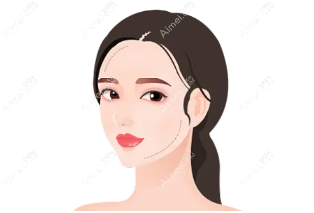 成都刘远程无痕筋膜提升手术实例www.aimei.com