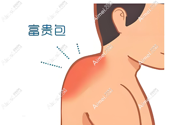 黄学峰医生富贵包是否骗局 黄学峰医生富贵包是否骗局