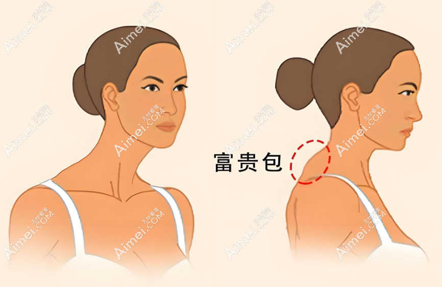 黄学峰医生富贵包预约联系方式获取www.aimei.com 黄学峰医生富贵包预约联系方式获取www.aimei.com