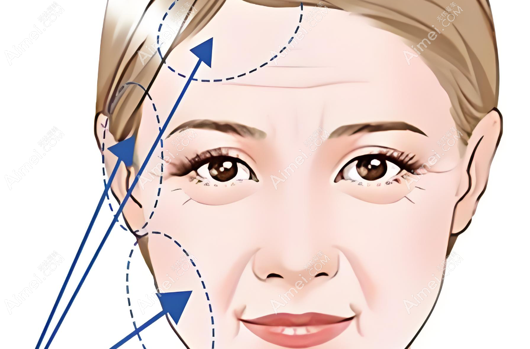 成都刘远程筋膜提升有失败实例吗？