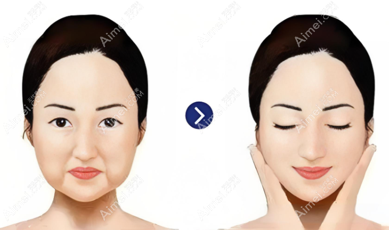 成都李建刚医美失败修复成功实例患者反馈分享www.aimei.com