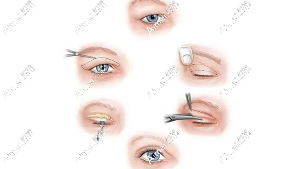 网传北京李燕双眼皮避雷?听双眼皮做失败的人说李燕双眼皮修复没黑料超种草 网传北京李燕双眼皮避雷?听双眼皮做失败的人说李燕双眼皮修复没黑料超种草