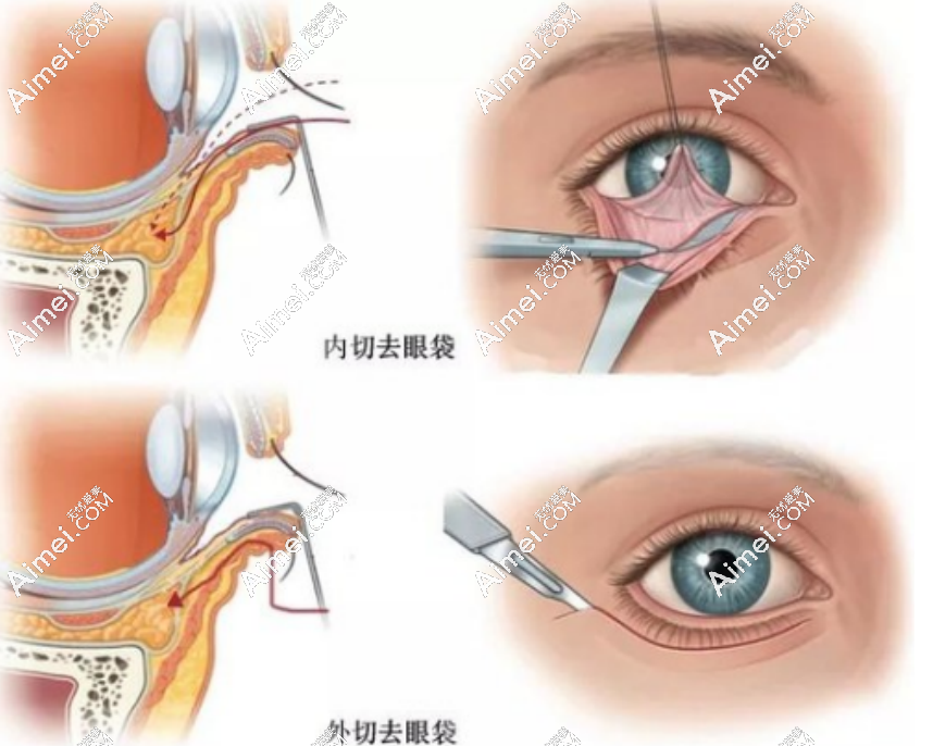 朱冠峰医生去眼袋