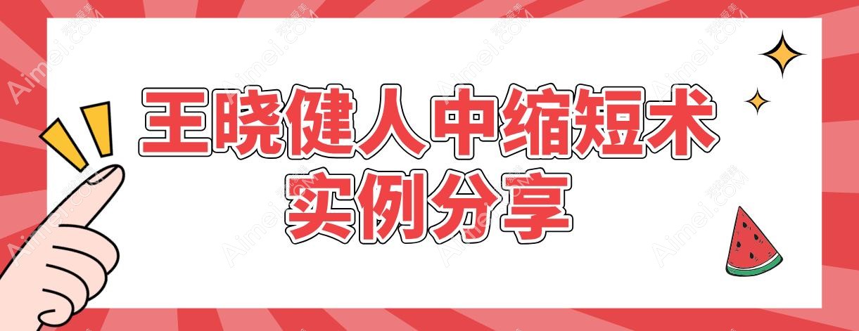 王晓健人中缩短术实例分享~术后得疤痕概率低+满意度高