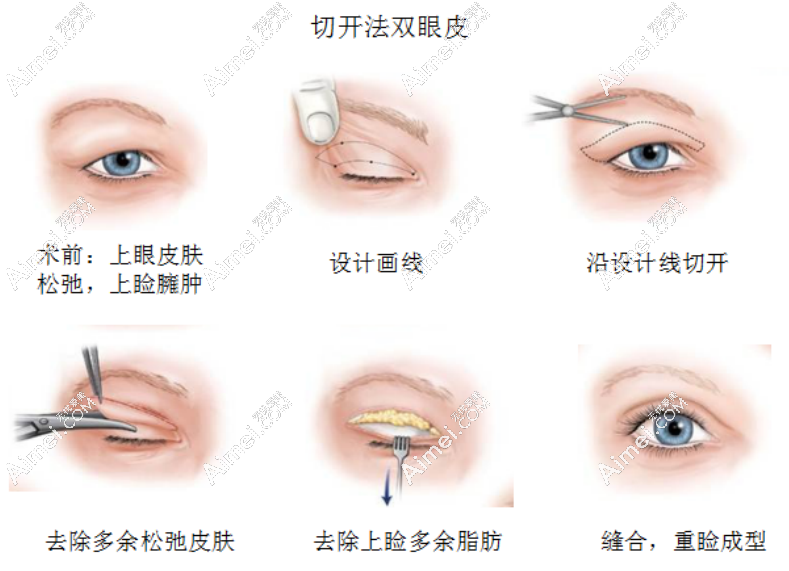 郑永生医生做双眼皮手术