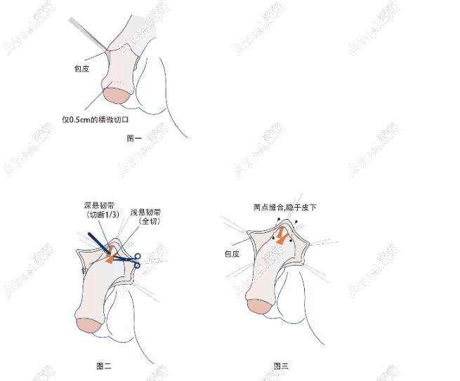 李世荣生殖整形价格