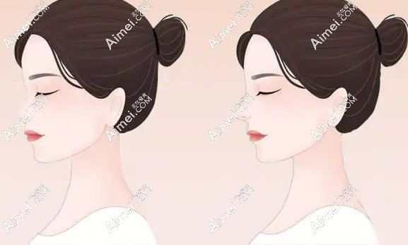 成都齊丙迪做鼻子好嗎?從齊丙迪真人鼻綜合實例來看他做鼻子真的好看