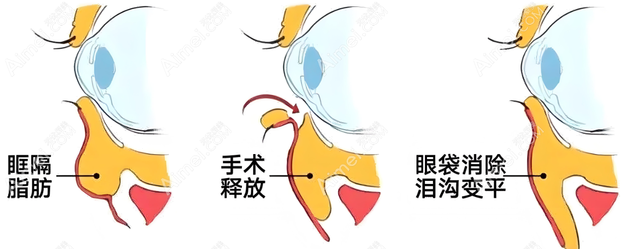 深圳朱冠峰祛眼袋手术www.aimei.com