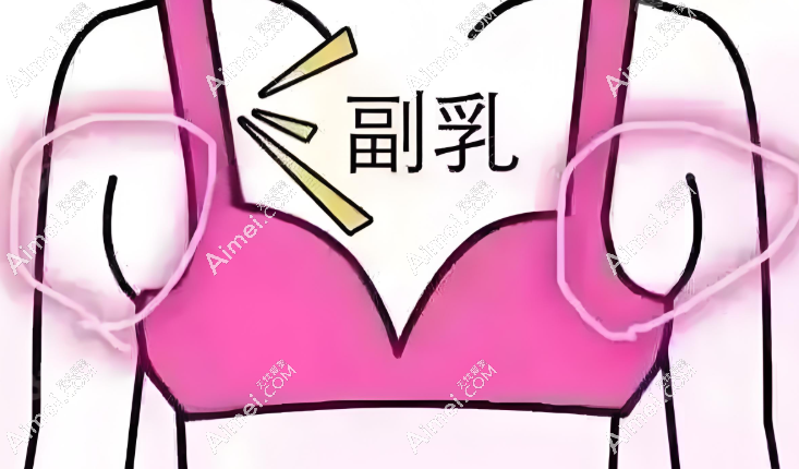 八大处穆大力切副乳疤痕小修复快,是国内排名前三的副乳切除医生,技术超绝!