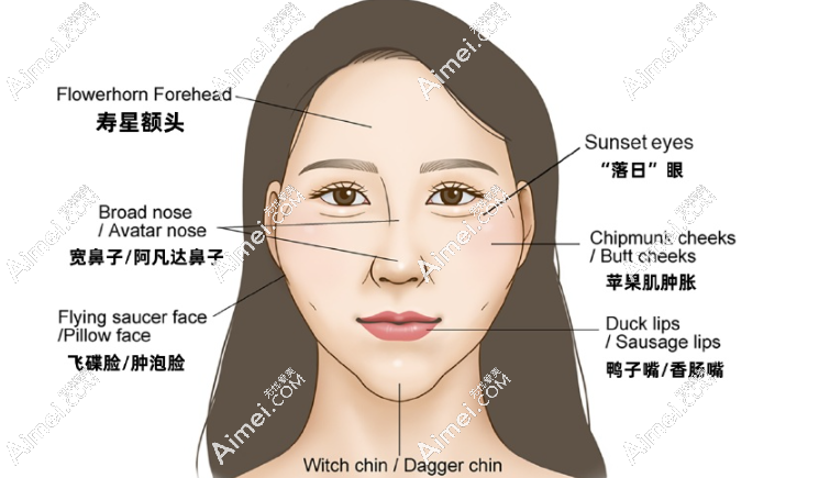 维密金雕治疗馒化脸好,通过消融+抽出后脸变薄了(附面部前后对比图)