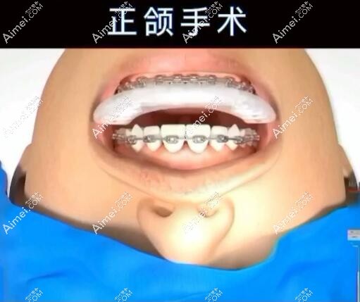 王涛医生做正颌手术怎么样？技术优势