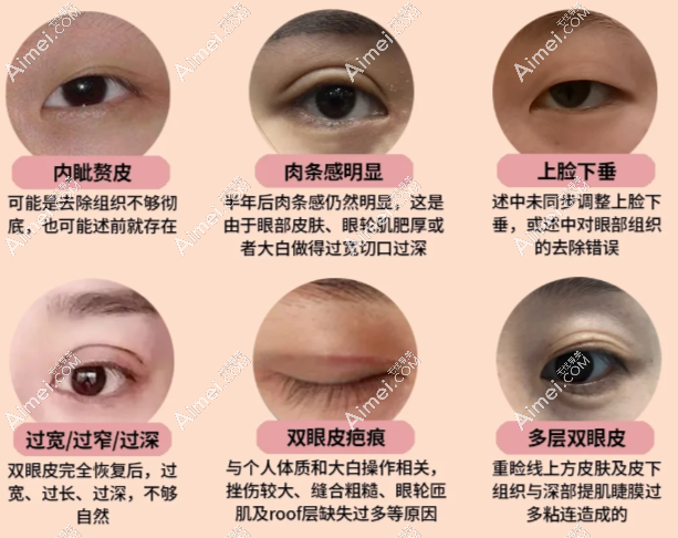 郑永生修复双眼皮靠谱 郑永生修复双眼皮靠谱