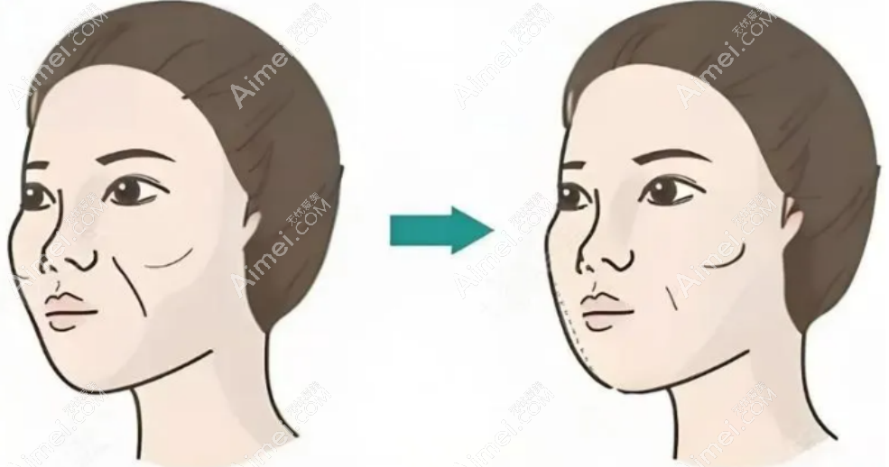 馒化脸