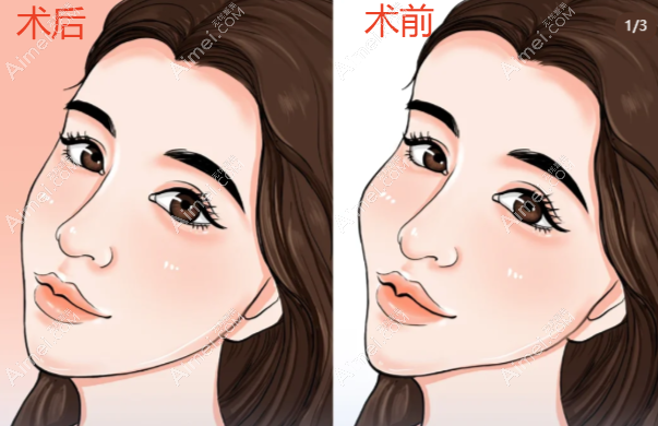 维密金雕面部前后对比照片图
