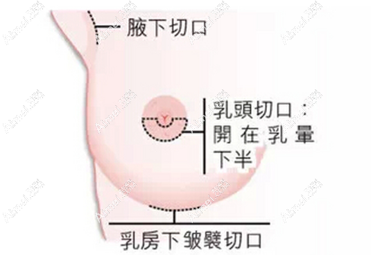 2025国内下皱襞隆胸医生排名前十名靠谱(创伤小瘢痕浅拆线完不咋痛,低至3w+)