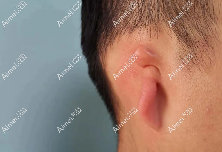 章慶國耳朵再造在國內(nèi)能排前五，但做再造耳手術(shù)費(fèi)用并不貴才4萬起
