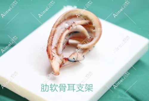 章庆国耳朵再造实例图