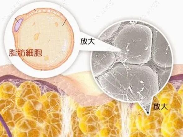 脂肪医生韦元强做自体脂肪丰胸失败结节取出修复好，技艺高超，信赖之选！