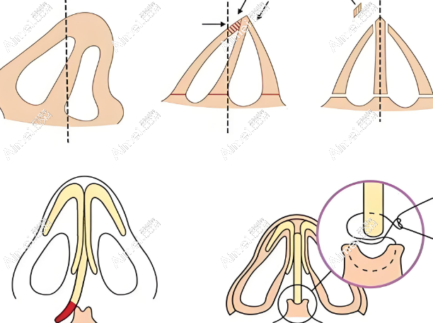 深圳文丰医生做鼻子技术怎么样 深圳文丰医生做鼻子技术怎么样
