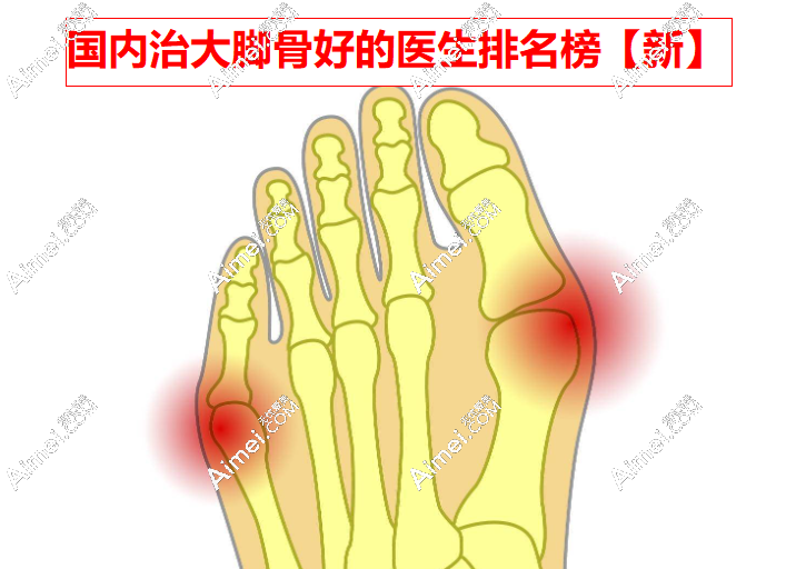 国内治大脚骨好的医生排名榜