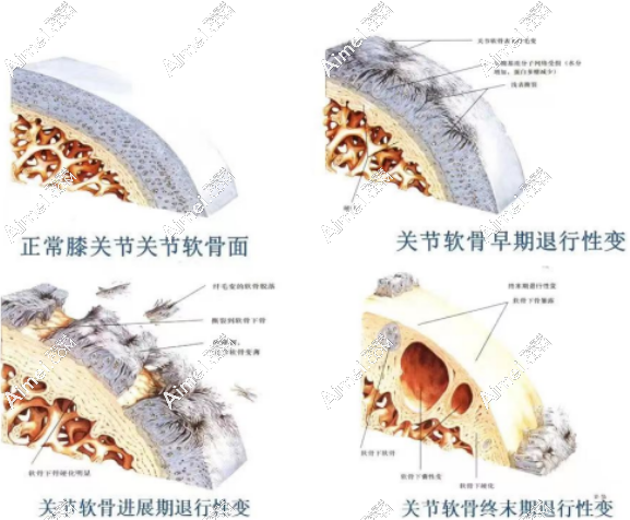骨性膝關(guān)節(jié)炎能治好嗎？能，(可特立)細(xì)胞療法從根本上治療膝關(guān)節(jié)炎