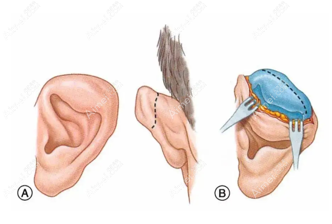 张正文耳再造排名前三!(另外两位是段伟强、余文林)耳朵畸形整形零失败实例 张正文耳再造排名前三!(另外两位是段伟强、余文林)耳朵畸形整形零失败实例