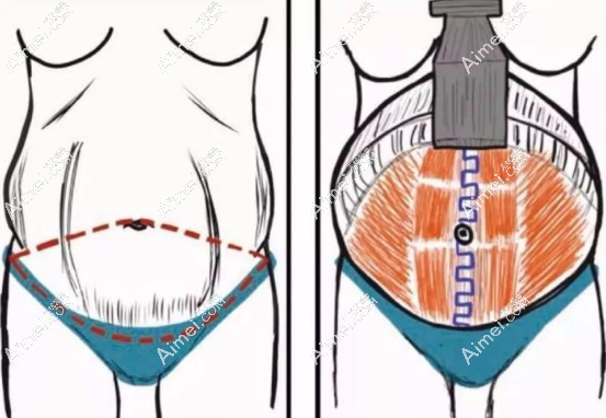 腹部拉皮手术www.aimei.com 腹部拉皮手术www.aimei.com