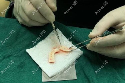 龚涛做半肋鼻综合和肋骨鼻修复好