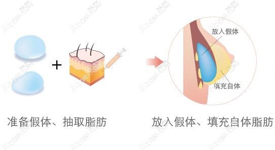 北京京城皮肤医院复合丰胸