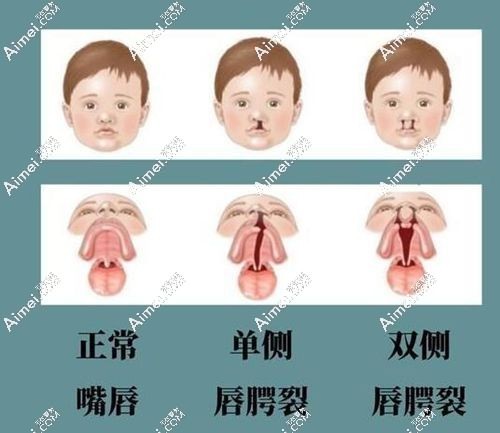 国内唇腭裂二期修复好的医院排名前十 国内唇腭裂二期修复好的医院排名前十