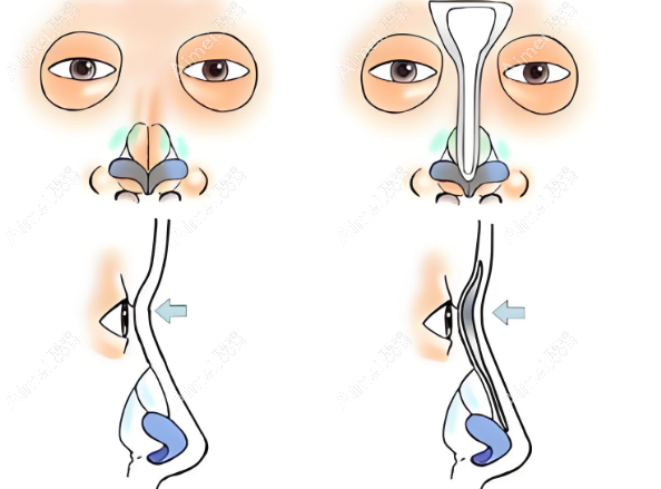 金柱翰做鼻子磨骨手术价格收费www.aimei.com 金柱翰做鼻子磨骨手术价格收费www.aimei.com