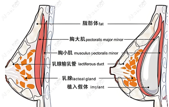 国内下皱襞隆胸手术www.aimei.com 国内下皱襞隆胸手术www.aimei.com