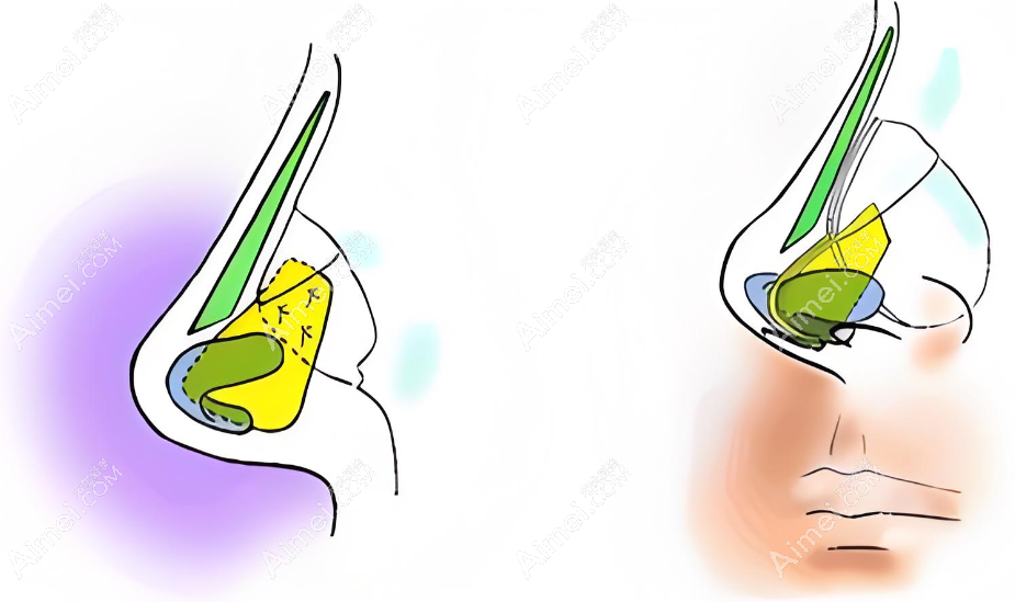 金柱翰做鼻子怎么样 金柱翰做鼻子怎么样