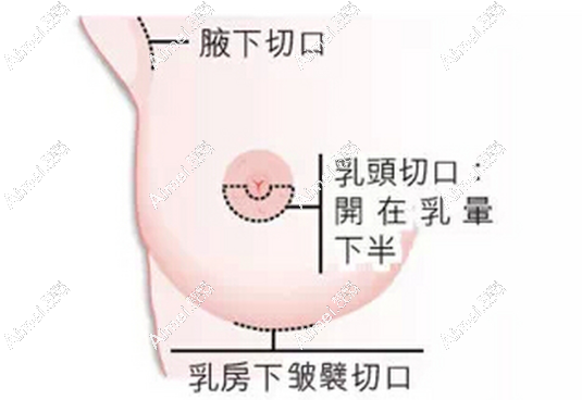 乳房下皱襞切口 乳房下皱襞切口
