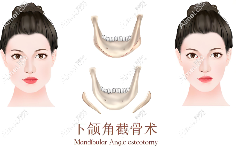 给明星整容的金柱翰医生怎么预约?联系南京友谊医院小助理预约他磨骨鼻子手术