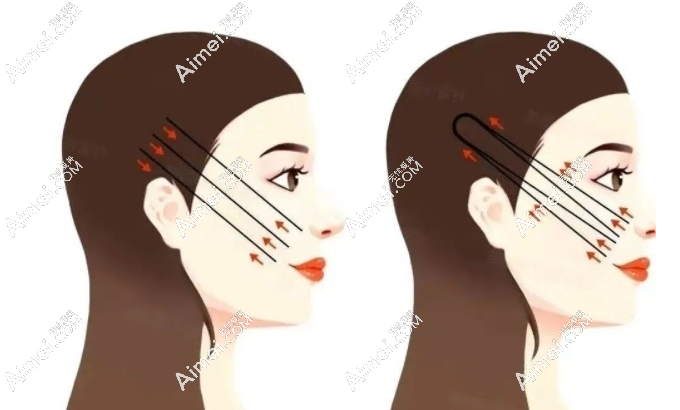2025成都筋膜提升医院排名:素美|懿和唯美|恒博天姿筋膜提升三件套做的好(均价39800元起)   爱美网