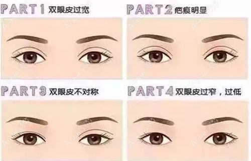 双眼皮修复类型.jpg