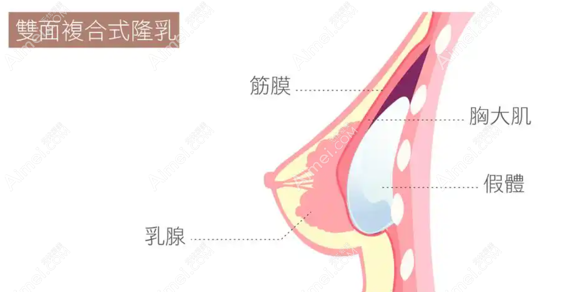 隆胸手术示意图