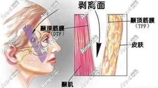 北京杨喆拉皮技术怎么样呢？杨俊在北京四季青橙医院做小拉皮技术好-价格68000元起