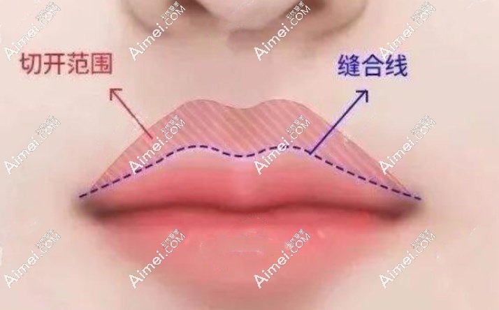 胡俊杰人中缩短做得好 爱美网
